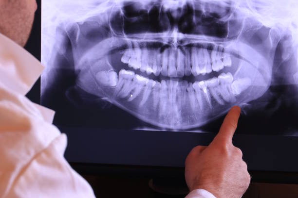 Best Emergency Wisdom Teeth Removal in Matamoras, PA